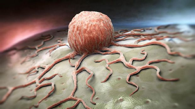 tumor